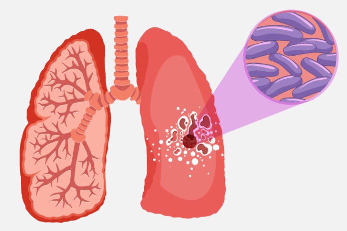 La Tuberculosis Es Curable Si Se Detecta A Tiempo Imss Nfasis